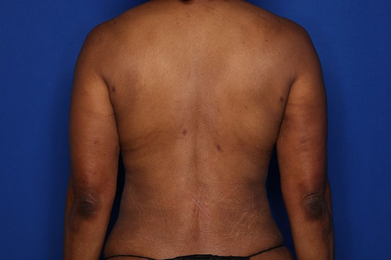 Tummy Tuck Before & After Gallery - Patient 897126 - Image 8