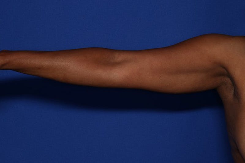 BodyTite™ Before and After Before & After Gallery - Patient 225233 - Image 5