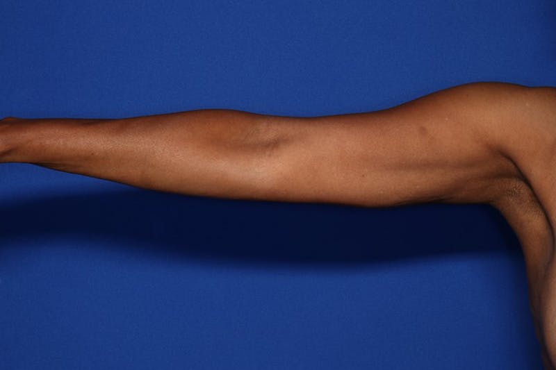 BodyTite™ Before and After Before & After Gallery - Patient 225233 - Image 6