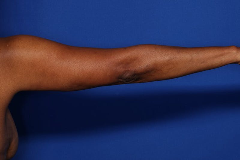 BodyTite™ Before and After Before & After Gallery - Patient 225233 - Image 4