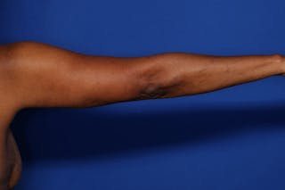 BodyTite™ Before and After Before & After Gallery - Patient 225233 - Image 4