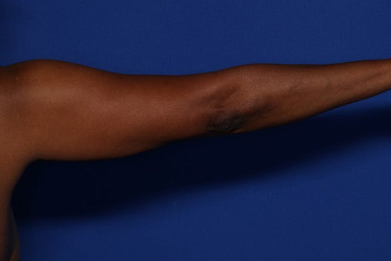 BodyTite™ Before and After Before & After Gallery - Patient 225233 - Image 3