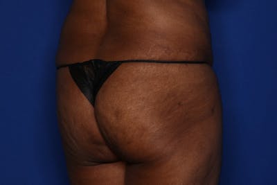 Brazilian Butt Lift Before & After Gallery - Patient 416286 - Image 1