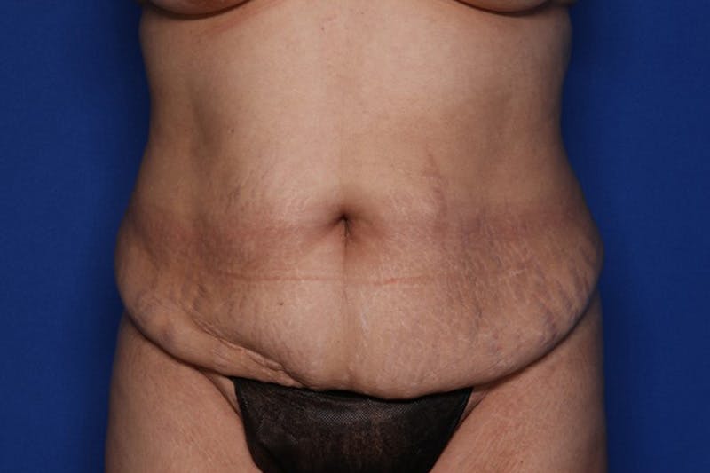 Tummy Tuck Before & After Gallery - Patient 196362 - Image 1