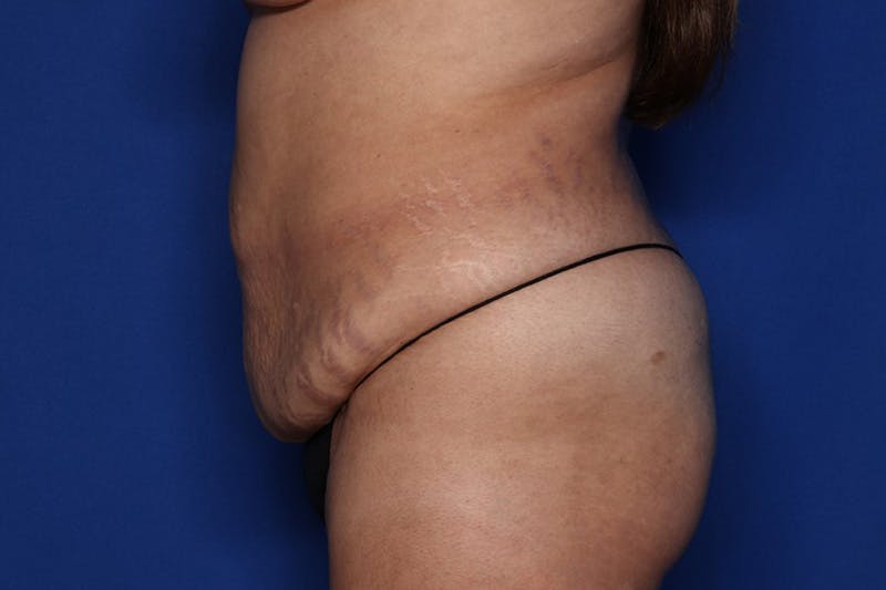 Tummy Tuck Before & After Gallery - Patient 196362 - Image 3
