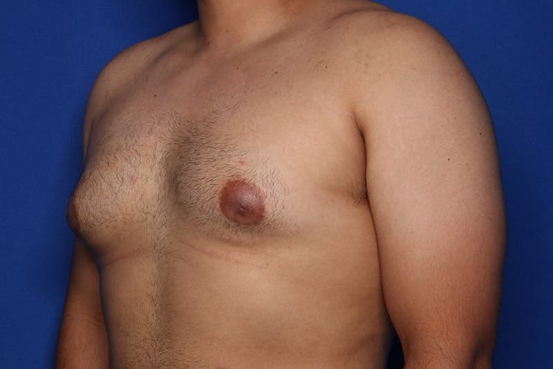 Gynecomastia (Male Breast Reduction) Before & After Gallery - Patient 129186 - Image 3
