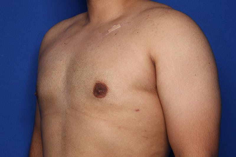 Gynecomastia (Male Breast Reduction) Before & After Gallery - Patient 129186 - Image 4