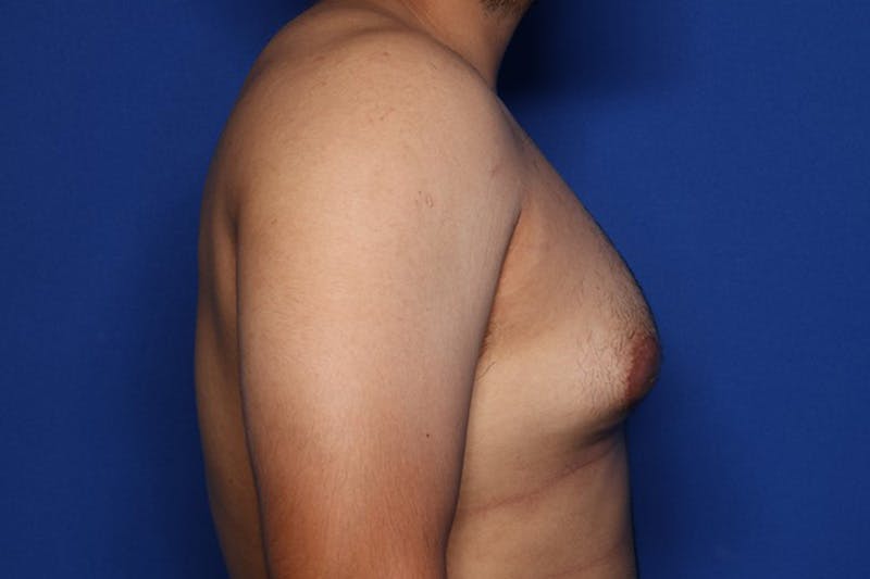 Gynecomastia (Male Breast Reduction) Before & After Gallery - Patient 129186 - Image 5