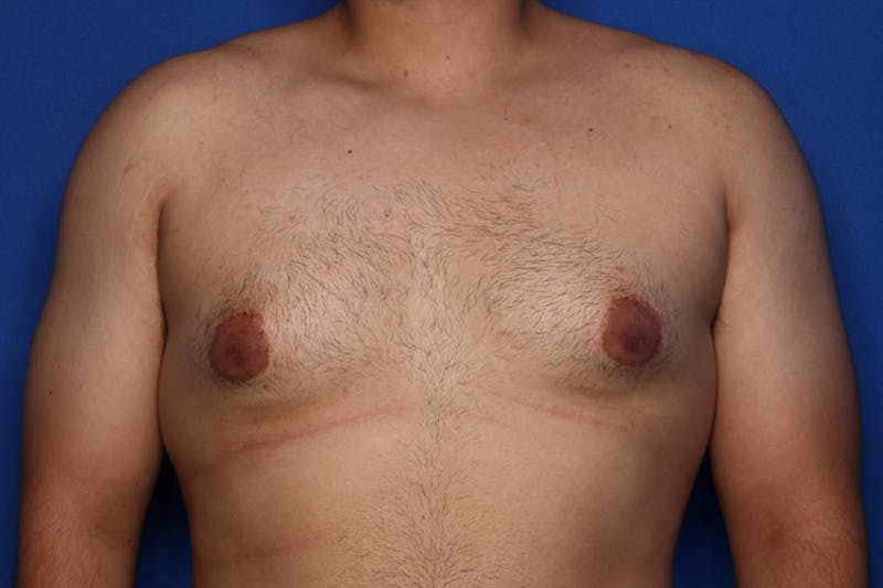 Gynecomastia (Male Breast Reduction) Before & After Gallery - Patient 129186 - Image 1