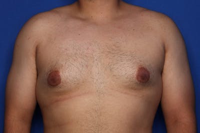 Gynecomastia (Male Breast Reduction) Before & After Gallery - Patient 129186 - Image 1