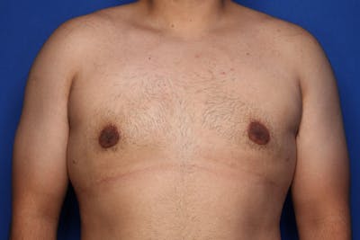 Gynecomastia (Male Breast Reduction) Before & After Gallery - Patient 129186 - Image 2