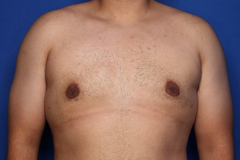 Gynecomastia (Male Breast Reduction) Before & After Gallery - Patient 129186 - Image 2