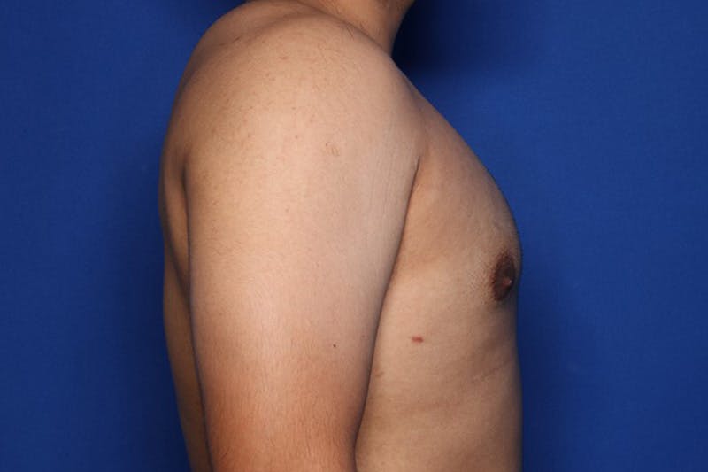 Gynecomastia (Male Breast Reduction) Before & After Gallery - Patient 129186 - Image 6