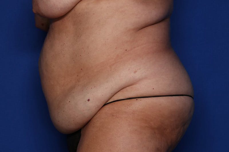 Tummy Tuck Before & After Gallery - Patient 248006 - Image 3
