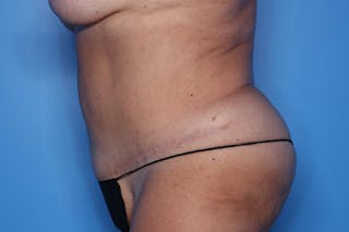 Tummy Tuck Before & After Gallery - Patient 248006 - Image 4