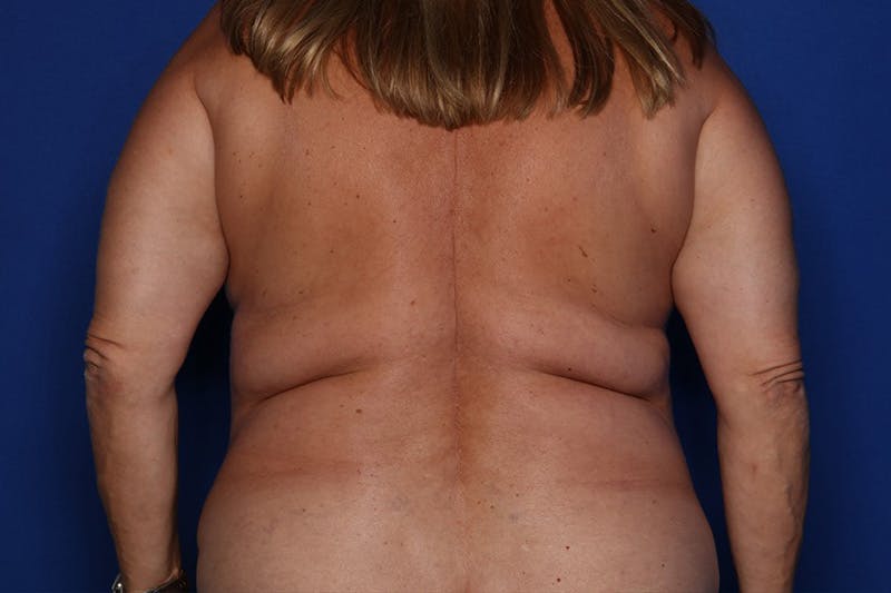 Liposuction Before & After Gallery - Patient 292443 - Image 1