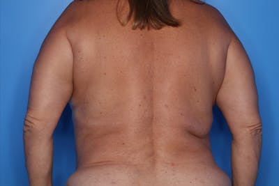 Liposuction Before & After Gallery - Patient 292443 - Image 2