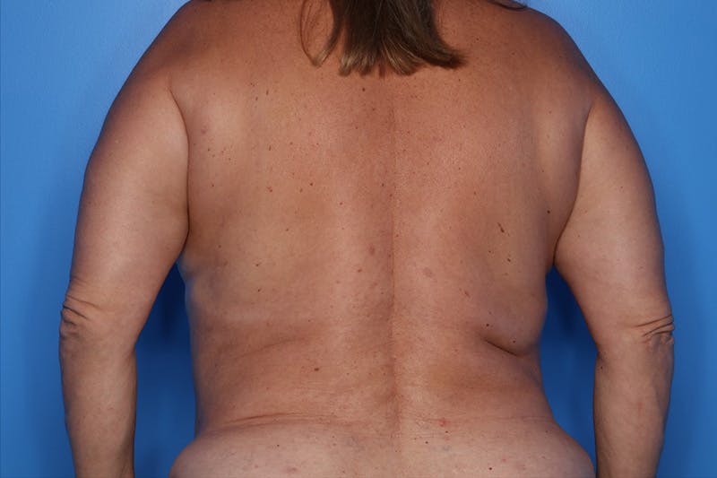 Liposuction Before & After Gallery - Patient 292443 - Image 2