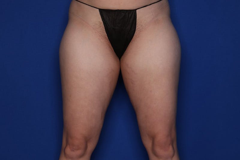 BodyTite™ Before and After Before & After Gallery - Patient 100374 - Image 3