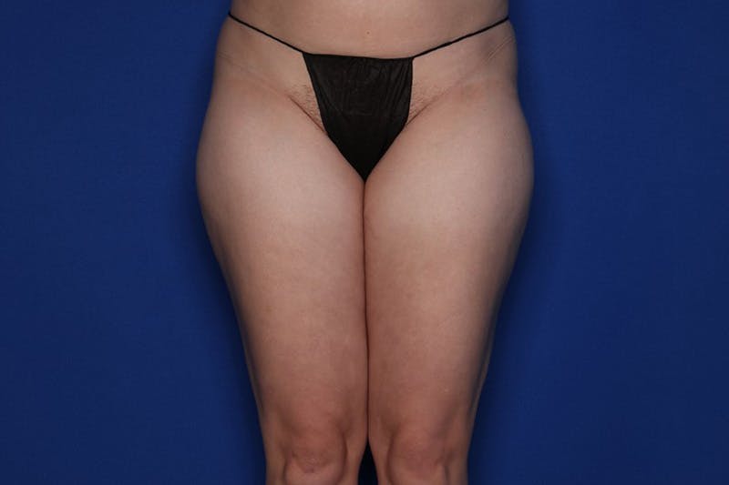 BodyTite™ Before and After Before & After Gallery - Patient 100374 - Image 1