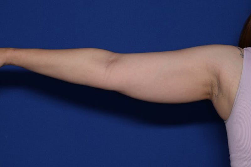 BodyTite™ Before and After Before & After Gallery - Patient 395395 - Image 1