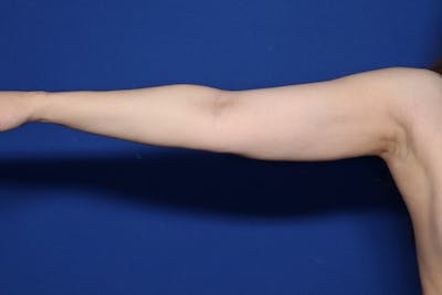 BodyTite™ Before and After Before & After Gallery - Patient 395395 - Image 2