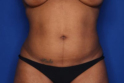 Liposuction Before & After Gallery - Patient 873926 - Image 2