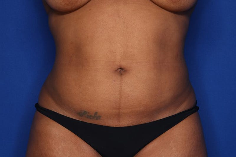 Liposuction Before & After Gallery - Patient 873926 - Image 2