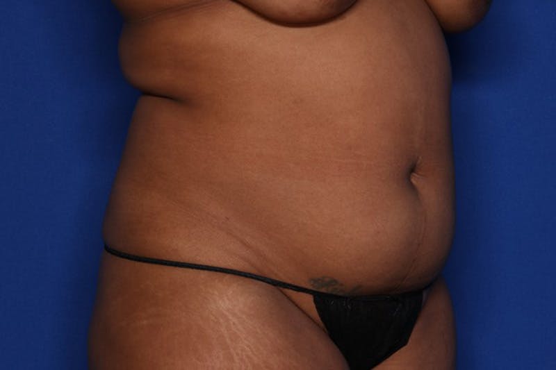 Liposuction Before & After Gallery - Patient 873926 - Image 3