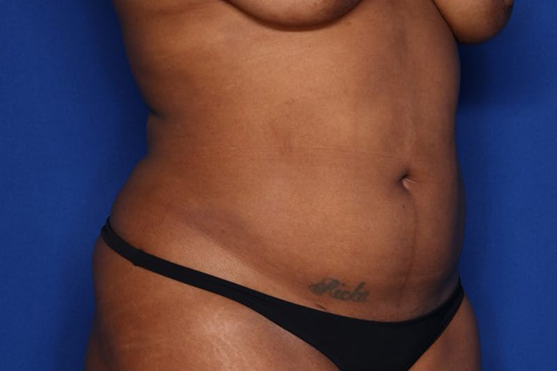 Liposuction Before & After Gallery - Patient 873926 - Image 4