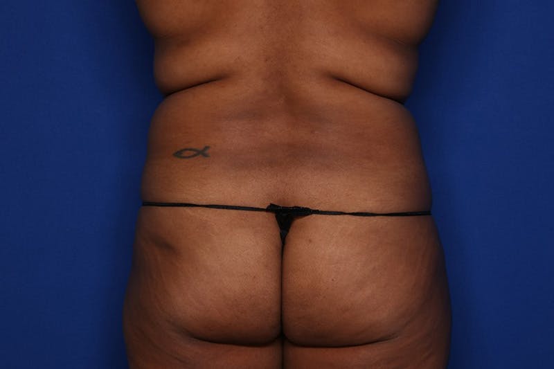 Liposuction Before & After Gallery - Patient 873926 - Image 5