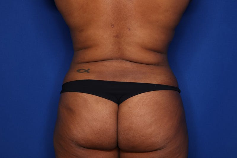 Liposuction Before & After Gallery - Patient 873926 - Image 6