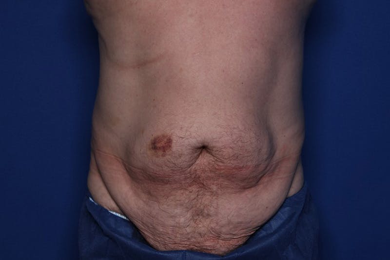 Tummy Tuck Before & After Gallery - Patient 235036 - Image 1