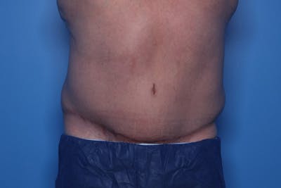 Tummy Tuck Before & After Gallery - Patient 235036 - Image 2