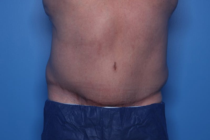 Tummy Tuck Before & After Gallery - Patient 235036 - Image 2
