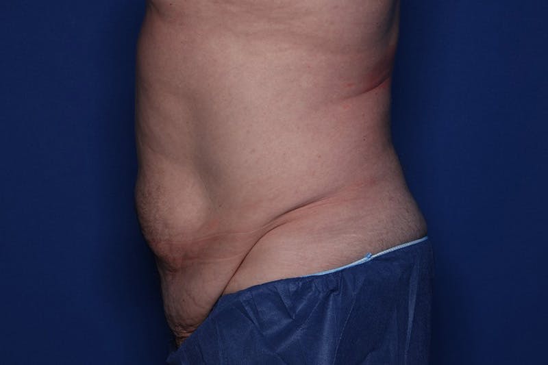 Tummy Tuck Before & After Gallery - Patient 235036 - Image 3