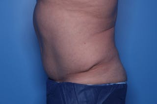 Tummy Tuck Before & After Gallery - Patient 235036 - Image 4