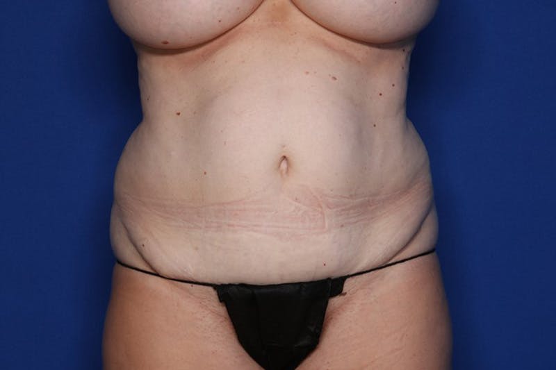Tummy Tuck Before & After Gallery - Patient 182376 - Image 1