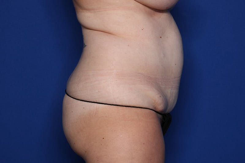 Tummy Tuck Before & After Gallery - Patient 182376 - Image 3
