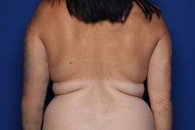 BodyTite™ Before and After Before & After Gallery - Patient 480882 - Image 1