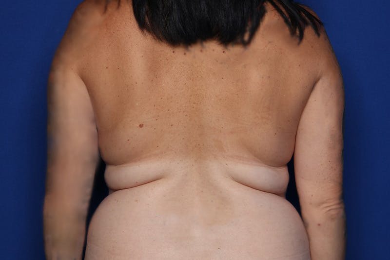 BodyTite™ Before and After Before & After Gallery - Patient 480882 - Image 1