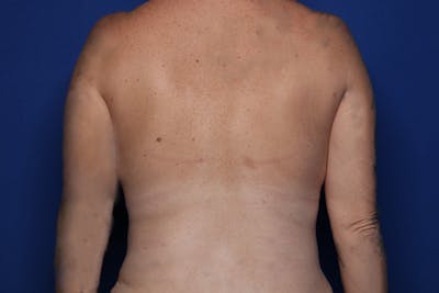 BodyTite™ Before and After Before & After Gallery - Patient 480882 - Image 2