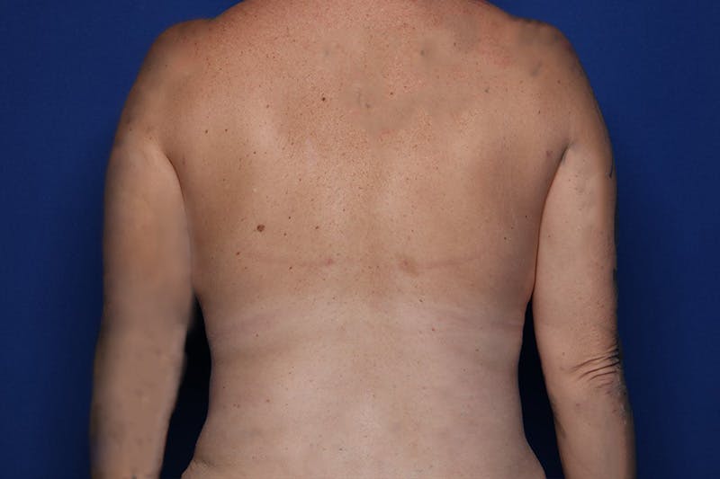 BodyTite™ Before and After Before & After Gallery - Patient 480882 - Image 2
