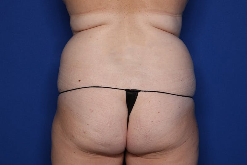 Liposuction Before & After Gallery - Patient 427056 - Image 1