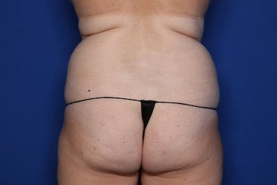 Liposuction Before & After Gallery - Patient 427056 - Image 1
