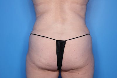 Liposuction Before & After Gallery - Patient 427056 - Image 2