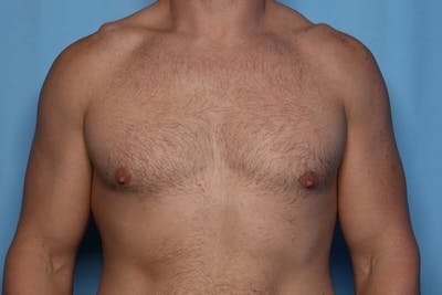 Gynecomastia (Male Breast Reduction) Before & After Gallery - Patient 168544 - Image 2