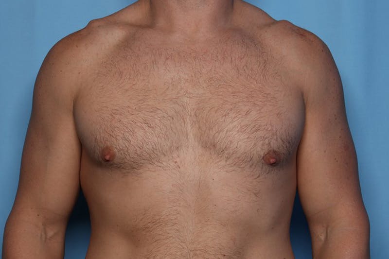 Gynecomastia (Male Breast Reduction) Before & After Gallery - Patient 168544 - Image 2