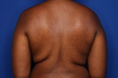 Liposuction Before & After Gallery - Patient 293890 - Image 1
