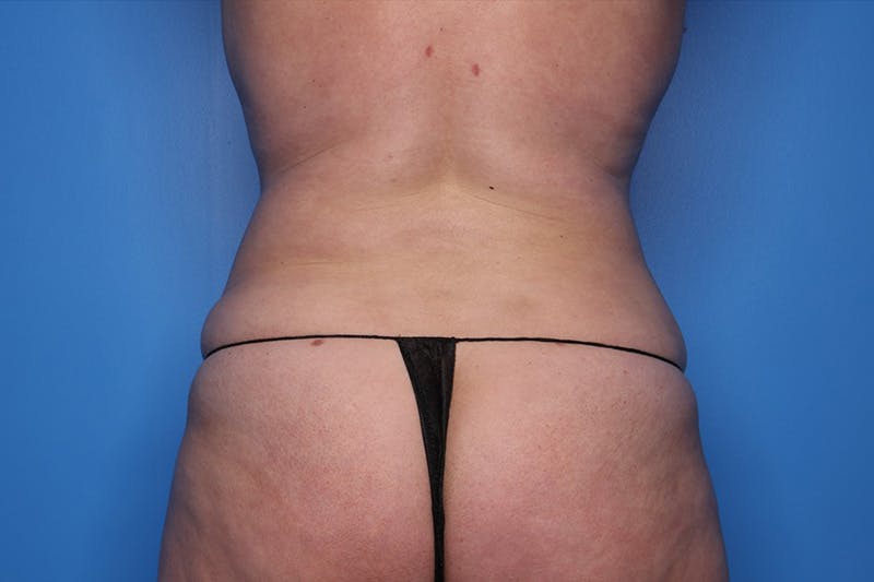 Liposuction Before & After Gallery - Patient 332847 - Image 4